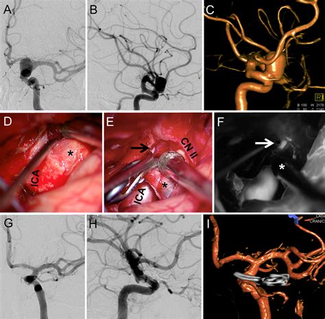 microsurgical clipping  ophthalmic artery aneurysms surgical results