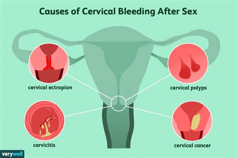 bleeding after sex everything you should know erectile