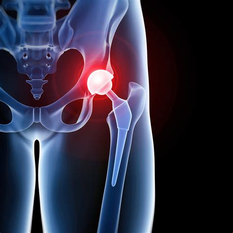 Hip Arthritis And Incontinence Symptoms Ballaratosm Ballarat