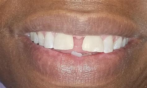 nola dentures  general dentistrys smile gallery filling