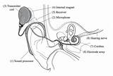 Cochlear Implant Implants Coil Transmitter Different Ear Head Side Device Types Cochlea sketch template