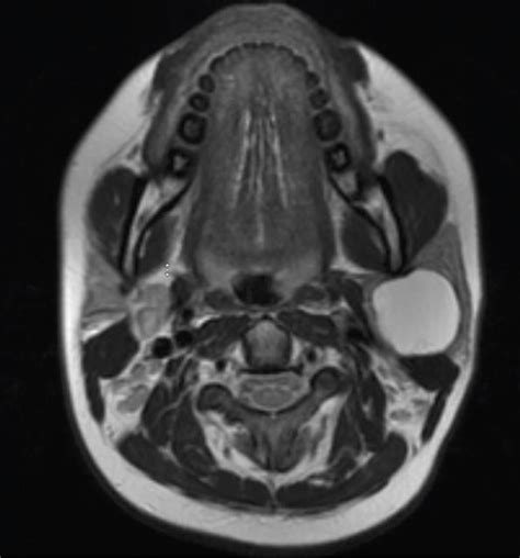 type ii  branchial cleft cyst presenting  parotid mass  case