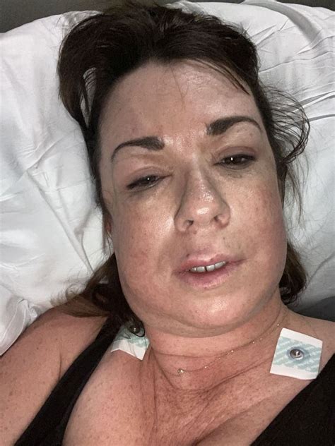 Mum Gets Lip Filler To Cheer Herself Up But Ends Up Almost Dying
