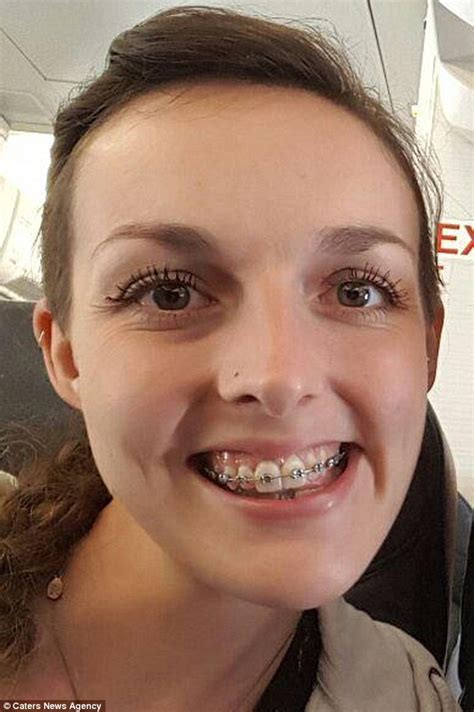 Woman Now Has The Perfect Smile After Surgery To Correct Wonky Jaw