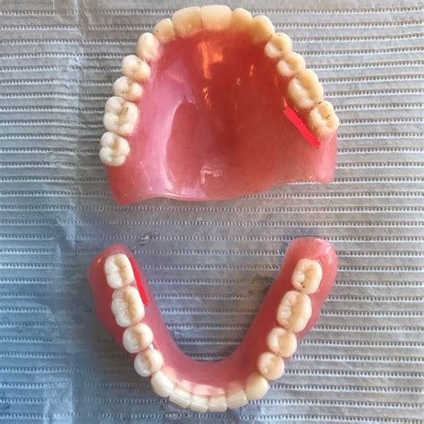 upper complete denture   implant overdenture  true life   dental student aegd