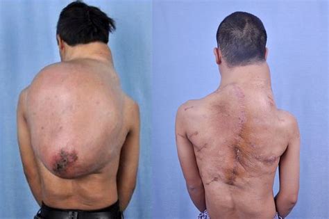 Yang Ha Pictured Real Life Quasimodo Has 13kg Tumour