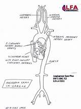 Coronary Artery Bypass Cabg Angiogram Grafts X2 Training Model Anatomical Sam Im Plus Two Lakeforestanatomicals sketch template