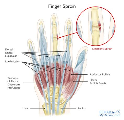 finger sprain rehab  patient