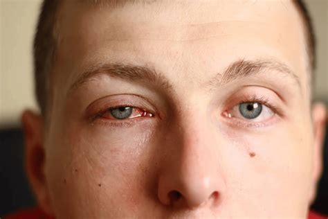 allergic conjunctivits   manage red itchy eyes book  eye test
