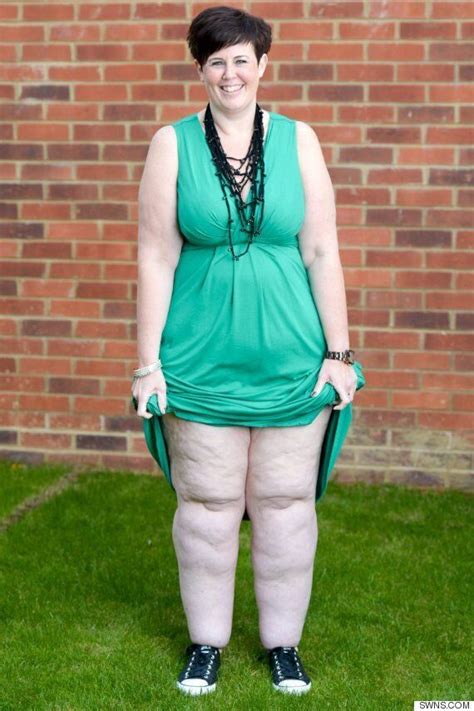 fat storing condition lipoedema leaves woman with 10 stone legs