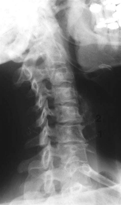 cervical spondylosis  neck pain  bmj