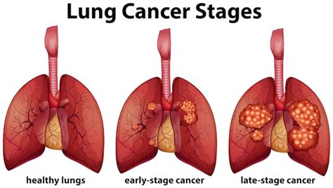 Different Stages Of Lung Cancer