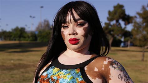Vitiligo Queen Is Comfortable In Her Own Skin Hot Bumbum