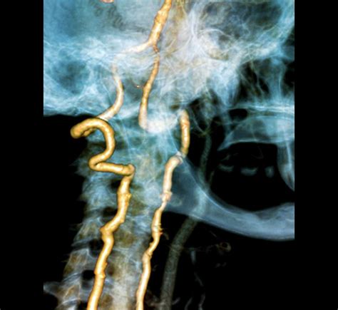 Vertebral Artery Insufficiency Photograph By Zephyr Fine Art America