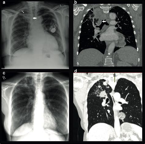Radiographic Features Of Tuberculosis Tb Disease Figure Shows Chest