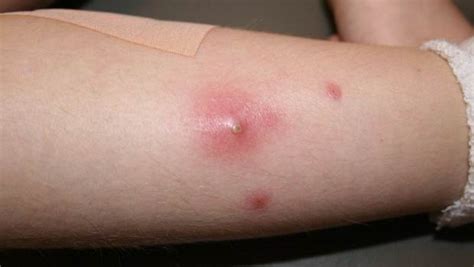 top natural home remedies for staph infection khaleej