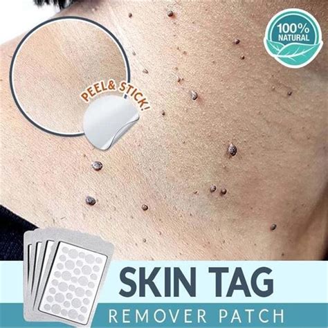 skin tag remover patch ance pimple patch plaster acne cream