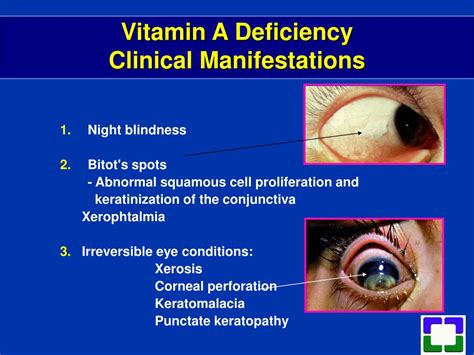 Ppt Fat Soluble Vitamin Deficiencies Powerpoint Presentation Free