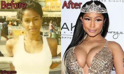 nicki minaj plastic surgery before and after image nickiminaj implantate bu bad plastic