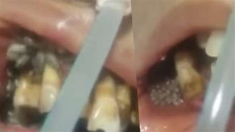 forget pimple popping   maggot  teeth video  horrific