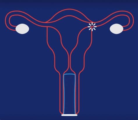 ¿qué Es El Condón Femenino Y Cuáles Son Sus Beneficios Tele 13