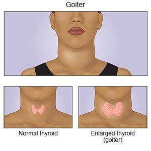 goiter hypothyroidism