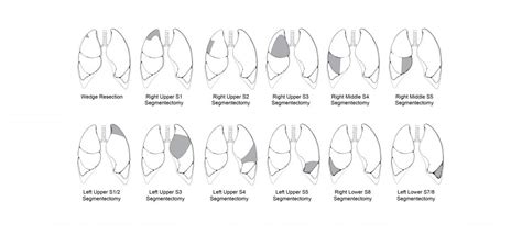 lung resection