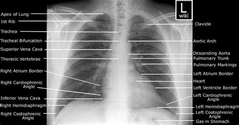 adult chest pa radiographic anatomy radiographic