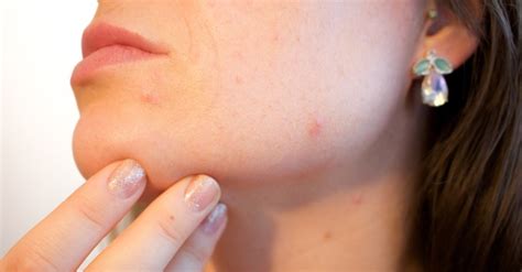 conheca cinco tipos de alergia na pele  quais  causas