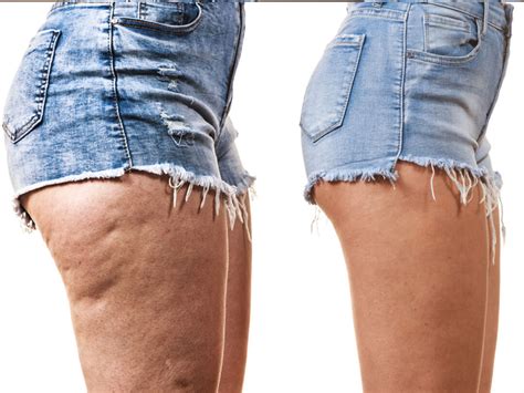 the best cellulite treatments and best ways to get rid of cellulitis fast