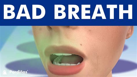 bad breath halitosis causes and treatment © youtube