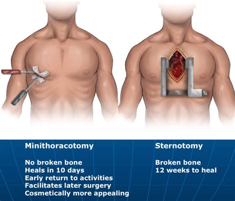 Keyhole Aortic Valve Surgery Is Safe And Effective The Keyhole Heart