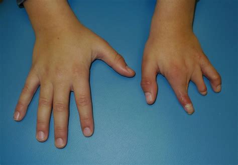 congenital hand deformities mybiosource learning center