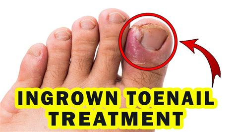 rid  ingrown toenail naturally home remedies