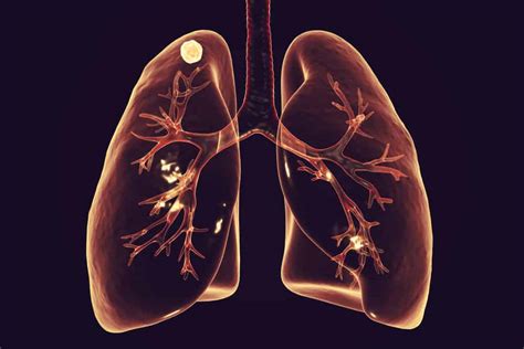 lung nodules  symptoms    doctor