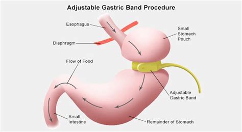 Gastric Band Illawarra Institute Of Obesity Surgery