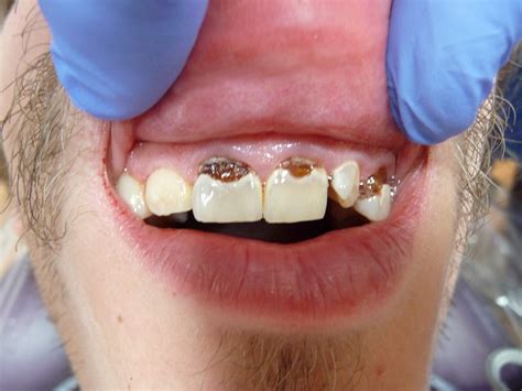 Dental Filling Front Teeth