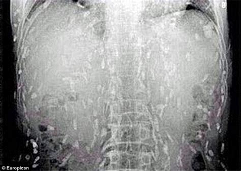 sushi leaves chinese man s body riddled with tapeworm parasites daily mail online