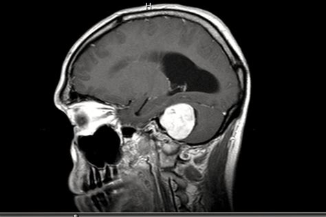 brain tumor diagnosed   acoustic neuroma part  hubpages