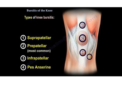 bursitis  knee orthopaedicprinciplescom