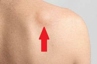 lump  shoulder  diagnosis treatment shoulder pain exp