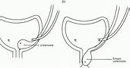 Bildergebnis für Ureterocele adult Form. Größe: 187 x 98. Quelle: abdominalkey.com