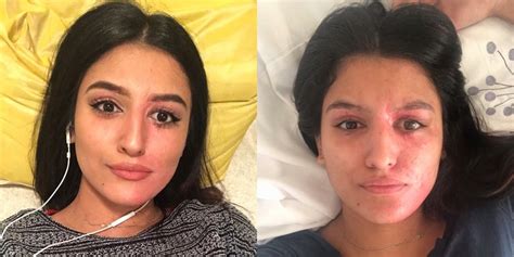 resham khan acid burn victim takes makeup free selfie popsugar beauty
