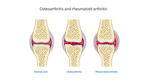 bio material   reverse arthritis