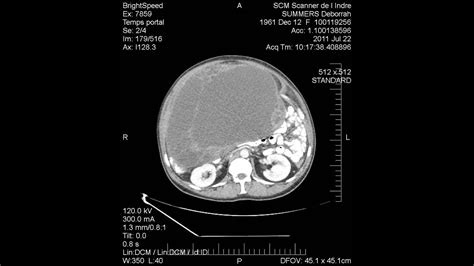 can a ct scan show cysts on ovaries ct scan machine