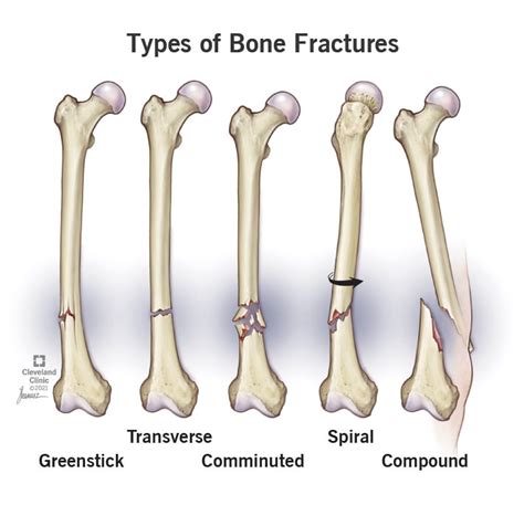 bone fractures types symptoms treatment