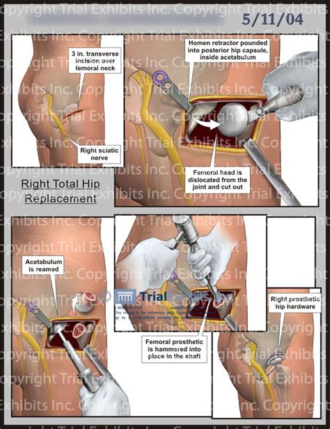 15 Best Images About Hip Replacement Surgery On Pinterest