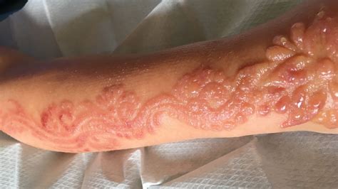 Girl Seven Is Left With Horrific Chemical Burns After Having Henna