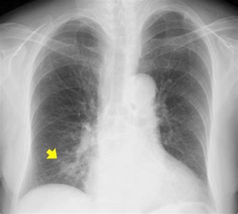 chest  ray shows  abnormal shadow     lung field