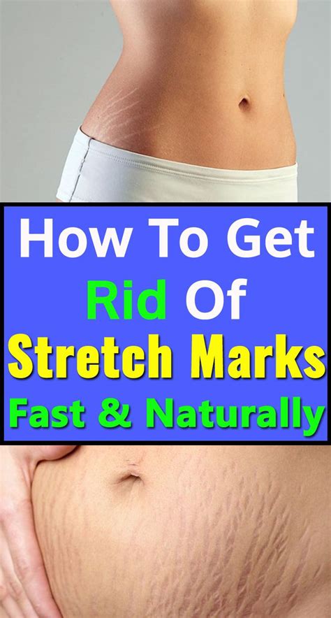 How To Get Rid Of Stretch Marks Fast And Naturally Stretch Marks